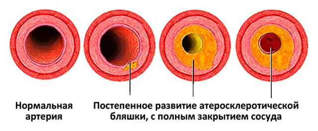 В сосудах бляшки: диагностика и терапия