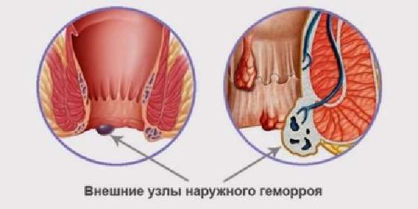 Выпал геморроидальный узел