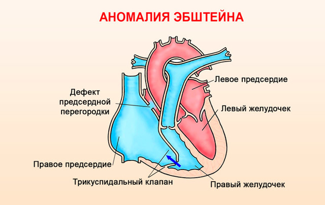 Регургитация трикуспидального клапана 1 степени