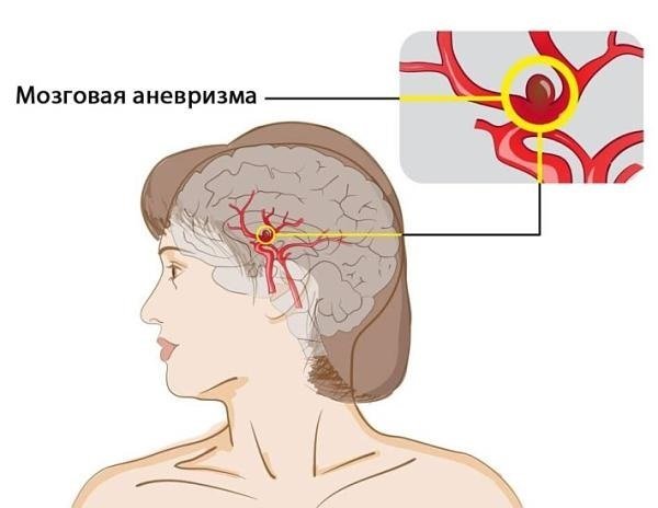 Сосуды головного мозга: симптомы, диагностика, лечение