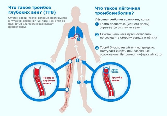Тромб в легких: тромбоз легочной вены – симптомы и лечение