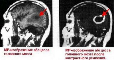 Абсцесс головного мозга - симптомы, лечение, причины, прогноз