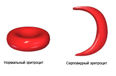 Серповидноклеточная анемия и типы ее наследования.