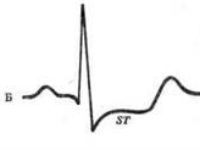 Стандартные отведения от конечностей - 1,2,3