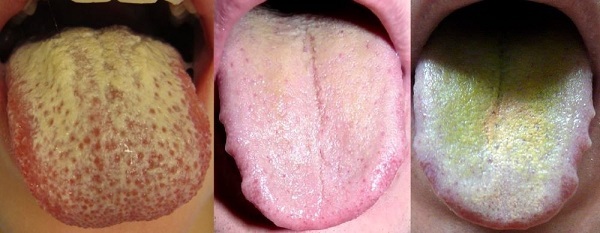 Желтый налет на языке у ребенка