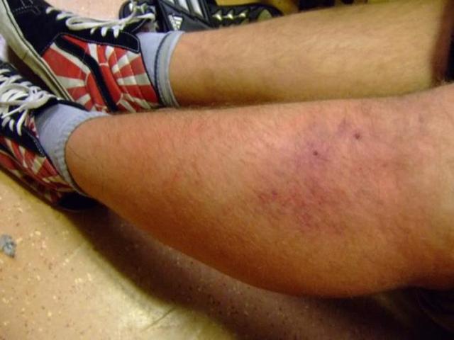 Рожа на ноге фото начальная стадия: Как начинается? - BadAcne