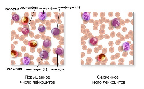 Пониженные лейкоциты в крови у ребенка