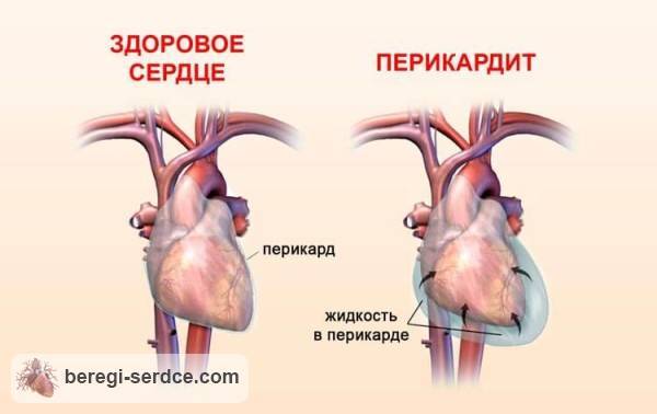 Давящая боль в области сердца