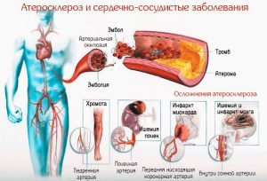 Атеросклероз аорты и алкоголь