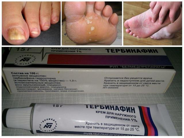Красная волчанка - что это за болезнь? (с фото)