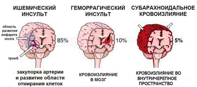 Причины инсульта и как он возникает. Знать всем!