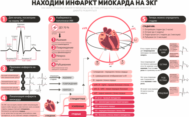 Инфаркт миокарда на ЭКГ: признаки, расшифровка