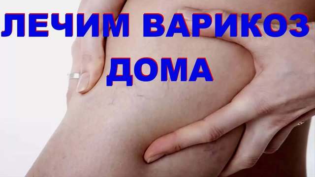 Народные средства от варикоза