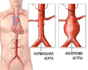 Питание при аневризма брюшной аорты -
