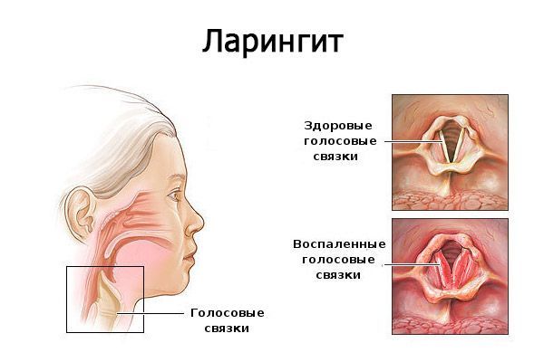 Ларингит и фарингит: симптомы и лечение у взрослых
