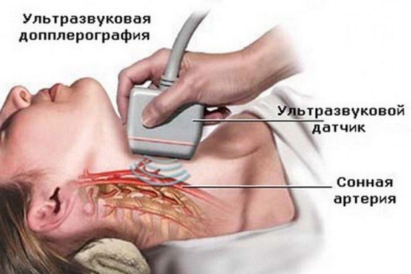 Синдром позвоночной артерии: симптомы, лечение, прогноз