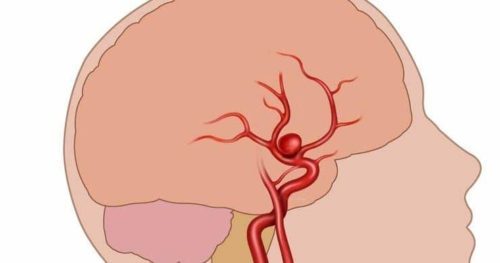 Сосуды головного мозга: заболевания, диагностика, лечение