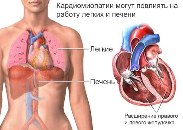 Алкогольная кардиомиопатия причина смерти — ВредКурения