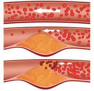 Уплотнение аорты – причины, симптомы, осложнения и лечение уплотнения аорты