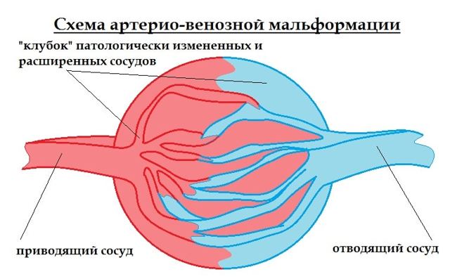 СОСУДИСТЫЕ МАЛЬФОРМАЦИИ ГОЛОВНОГО МОЗГА