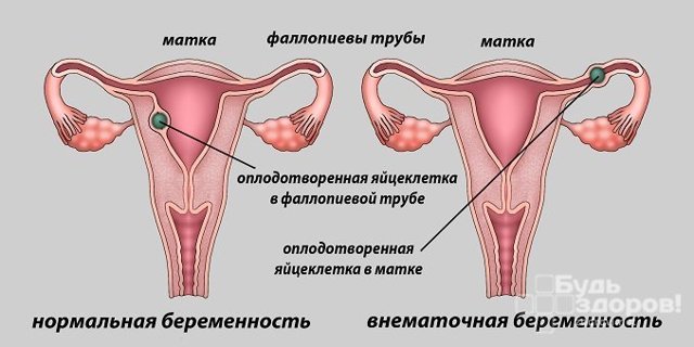 Анализ крови на ХГЧ - расшифровка, как и когда сдавать кровь на ХГЧ