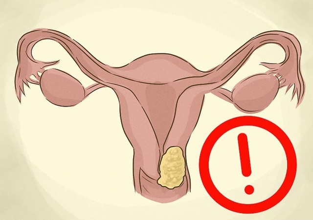 Сколько живут с раком шейки матки 4 стадии и есть ли шансы?