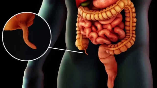 Хронический аппендицит у женщин и мужчин – симптомы, диагностика, лечение