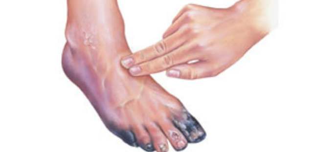 Мазь от гангрены - Все про гипертонию