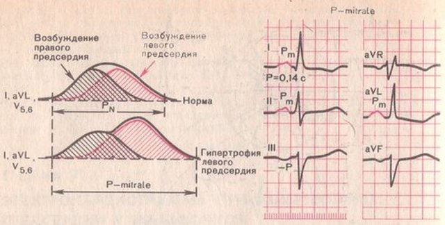 Нагрузка на левое предсердие - Все про гипертонию