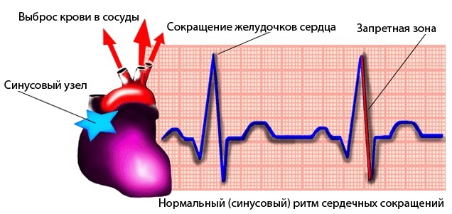 Как снять приступ аритмии в домашних условиях