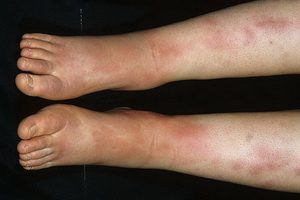 Васкулит мозга