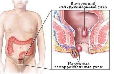 Геморрой: причины возникновения у мужчин и женщин, причины обострения