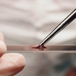 Тромбоцитопения: причины и лечение у взрослых