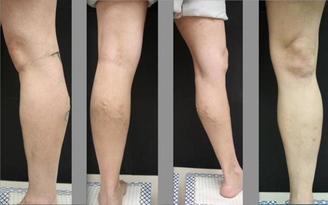 Болезни сосудов ног, лечение сосудов нижних конечностей