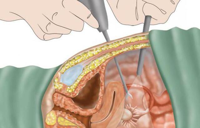 Киста яичника у женщин – причины, признаки и симптомы кисты левого и правого яичника у женщин. Последствия и разрыв кисты