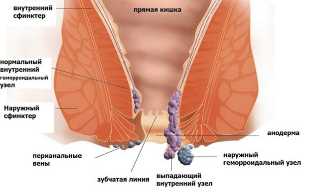 Геморрой - причины, симптомы, диагностика и лечение