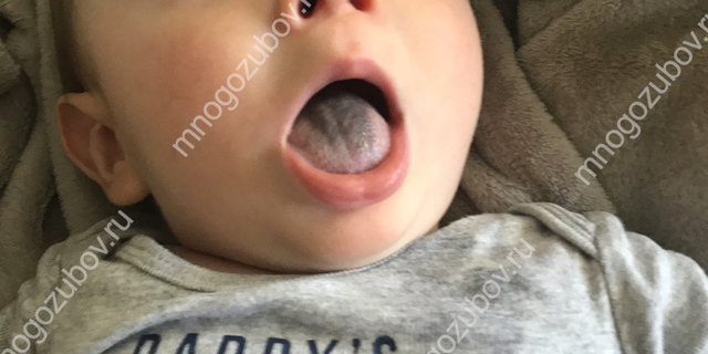 Черный налет на языке — начало больших проблем