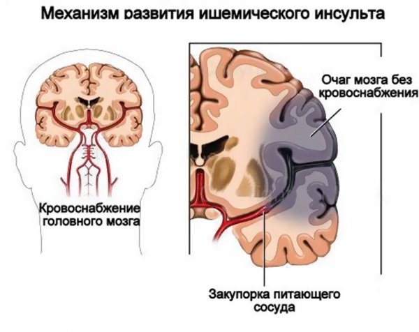 Инсульт левая или правая сторона, последствия, сколько живут