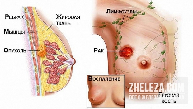 Боль в правой груди: что это может означать