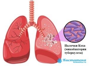 Гипоплазия легких - причины, симптомы, диагностика и лечение