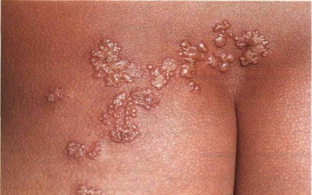 ЛИМФОЦИТЫ В КРОВИ У РЕБЕНКА ПОВЫШЕНЫ: [причины, лечение]