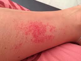 Васкулит на ногах - что это такое и как лечить?