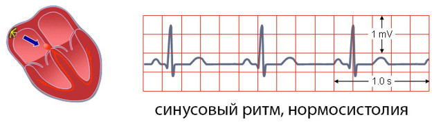 Нормосистолия, тахисистолия и брадисистолия на ЭКГ: что это, норма и патология