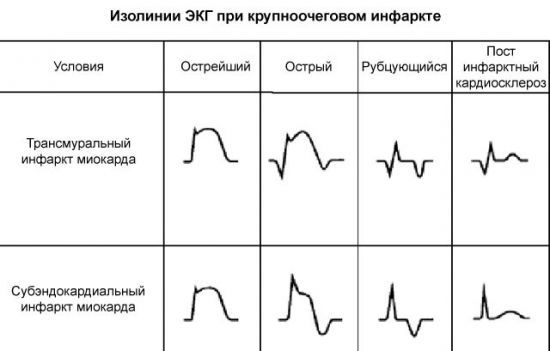 ЭКГ при инфаркте миокарда: фото пленок и расшифровка признаков