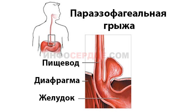 Что делать, если беспокоит жжение в области сердца