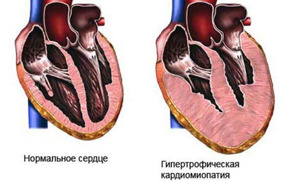 Заболевание бычье сердце