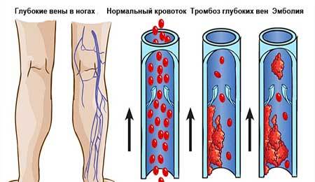 Тромбоз. Тромбофлебит вен нижних конечностей. Лечение и симптомы тромбоза и тромбофлебита.