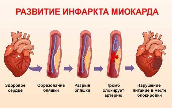 Классификация инфаркта миокарда: основные виды, формы и стадии