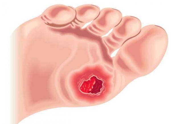 Трофическая язва - причины, симптомы, лечение, профилактика