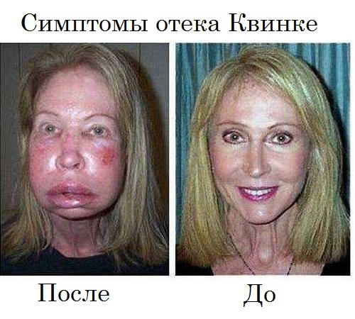 Ангионевротический отек (или отек Квинке): фото, лечение